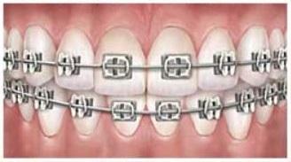 Metal braces provider