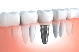 Dental Implants, Crowns